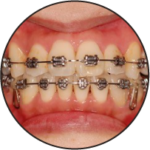 メタルブラケット