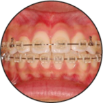 クリアブラケット