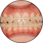 <span class="medatanai">目立たない矯正</span></br>セラミックブラケット