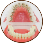 <span class="medatanai">目立たない矯正</span></br>ハーフリンガル